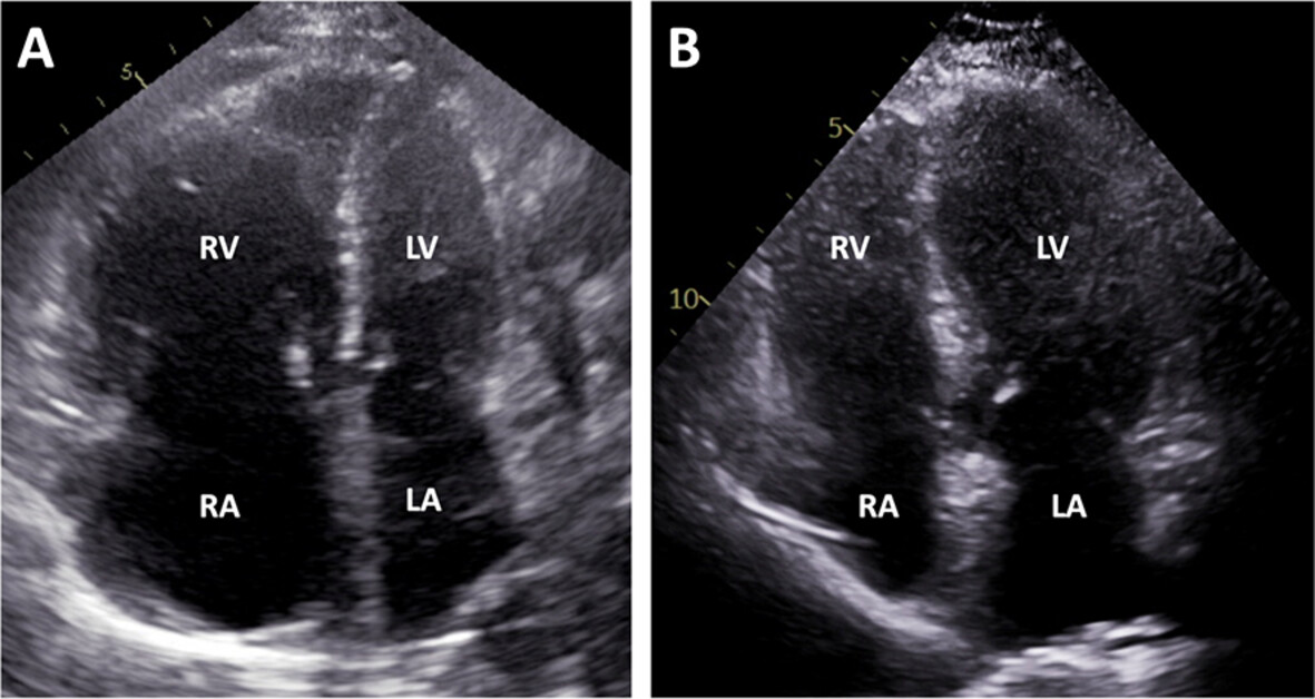 Dasatinib-Induced Pulmonary Arterial Hypertension in Chronic Myeloid Leukaemia: A Case Report and Literature Review Issue 3, 2025