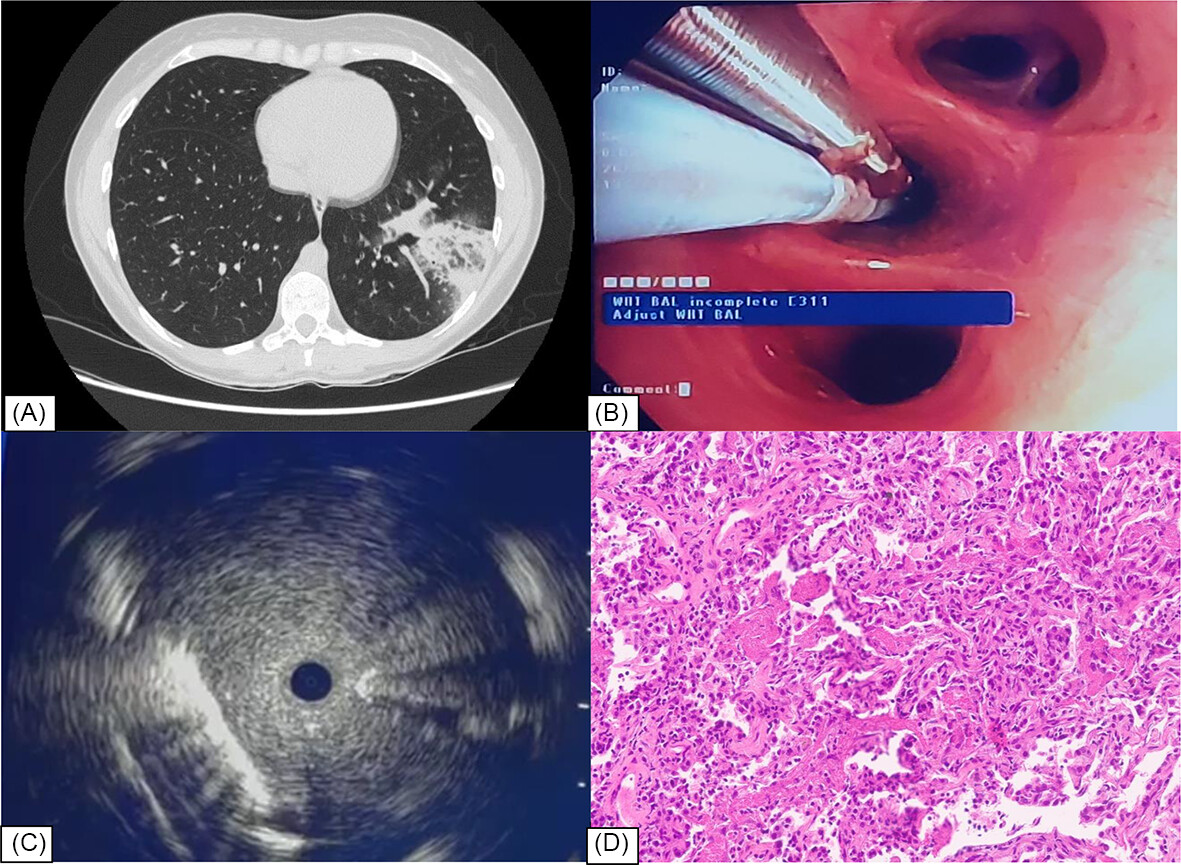Transbronchial lung cryobiopsy under real-time radial EBUS: First report on a novel twist of the classical technique Issue 7, 2024