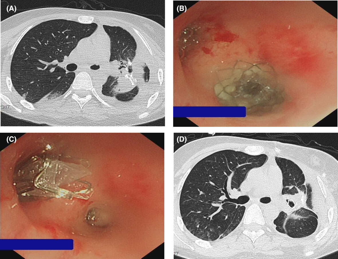 A novel approach involving reversed placement of endobronchial valves combined with retrograde methylene blue instillation for the localization of multifocal bronchopleural fistula Issue 2, 2024