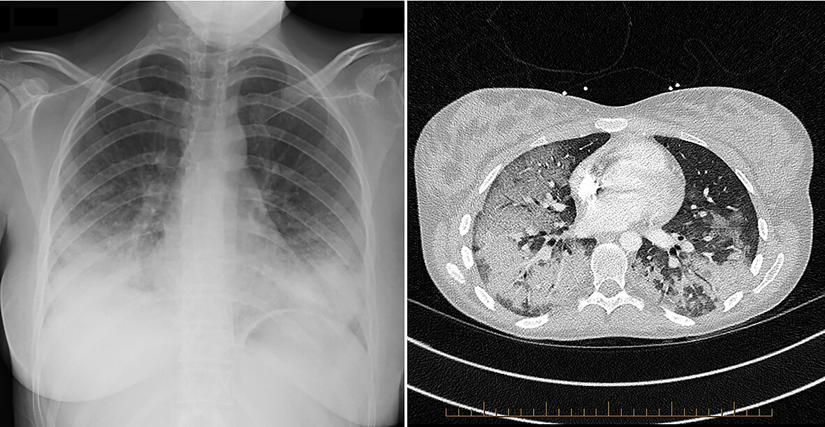 Trimethoprim-sulfamethoxazole acute respiratory distress syndrome requiring lung transplantation Issue 7, 2024