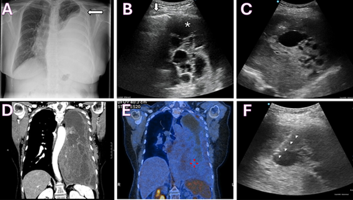 Distinct Ultrasound Features of Giant Solitary Fibrous Tumour of the Pleura: A Case Report Issue 6, 2025