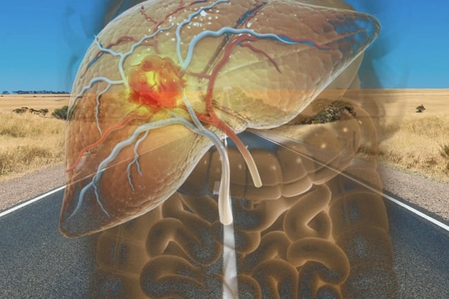 Decreased survival in rural hepatocellular carcinoma
